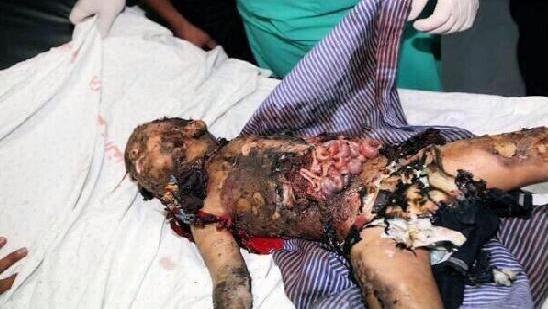 Abu Khdair: A Child Burned Alive By A zionist Rabbi 
